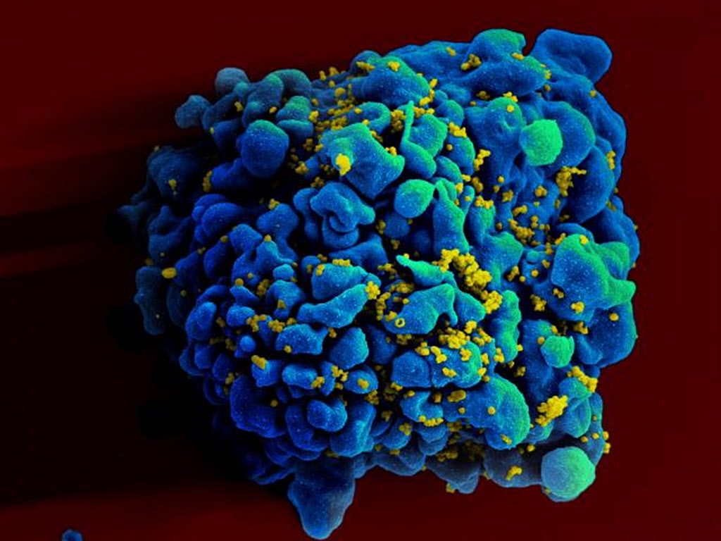 This April 12, 2011 electron microscope image made available by the National Institute of Allergy and Infectious Diseases shows an H9 T cell, blue, infected with the human immunodeficiency virus (HIV), yellow. Photograph by: Associated Press , file photo
